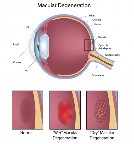 explaining macular degeneration